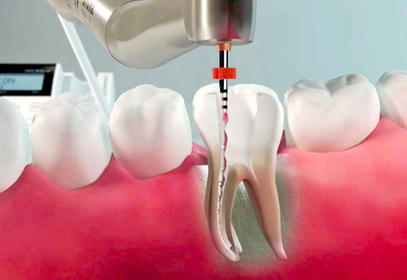 Endodonzia